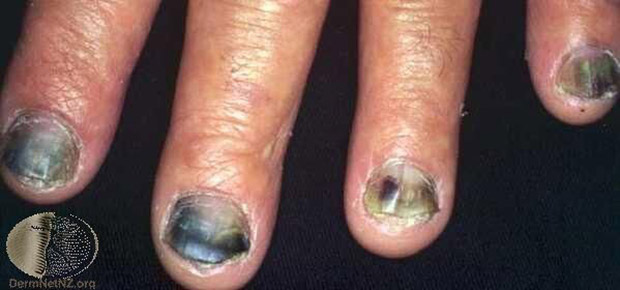 灰指甲如何治療、保養與預防?醫師 4 關鍵完整解答_img_2