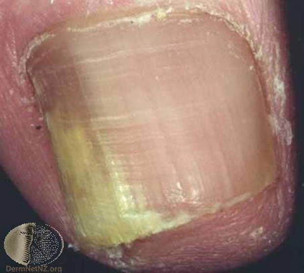 灰指甲如何治療、保養與預防?醫師 4 關鍵完整解答_img_5