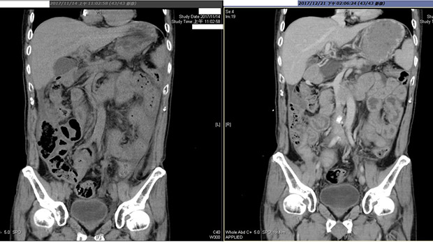 胰臟癌轉移腹膜差點「餓死」!感冒藥救他一命_img_1