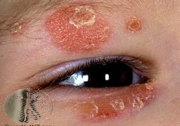 乾癬如何治療、保養與預防?醫師 3 大關鍵解答_img_1