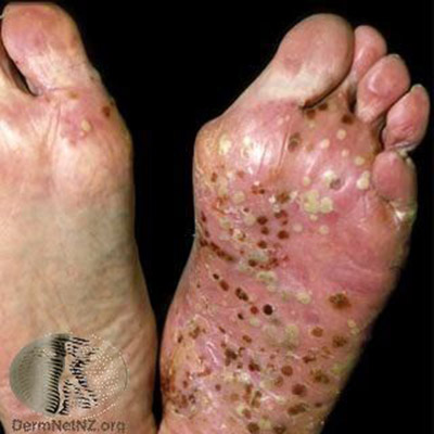 乾癬如何治療、保養與預防?醫師 3 大關鍵解答_img_4