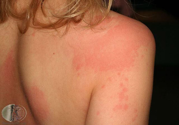 蕁麻疹如何治療、保養與預防?醫師圖文完整說明_img_1