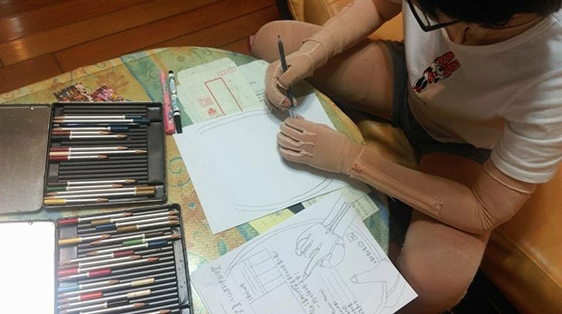 與燒傷的疤痕拔河,攣縮、見紅是家常便飯_img_1