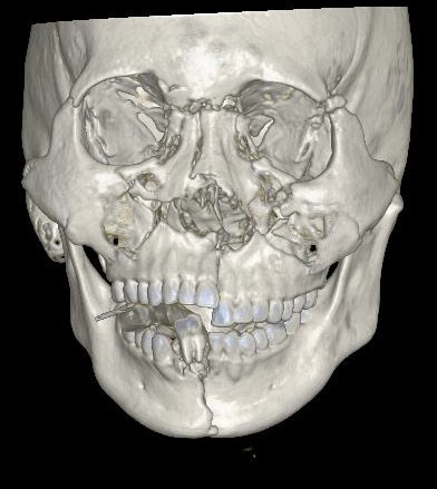 一張車禍 X 光圖,讓你秒懂全罩安全帽的重要_img_1