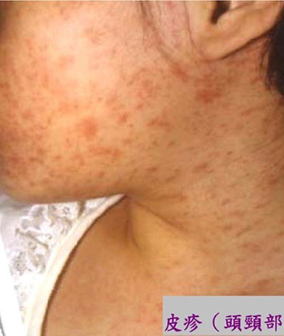 桃園麻疹增至3例接觸373人,疑似症狀勿自行就醫_img_1