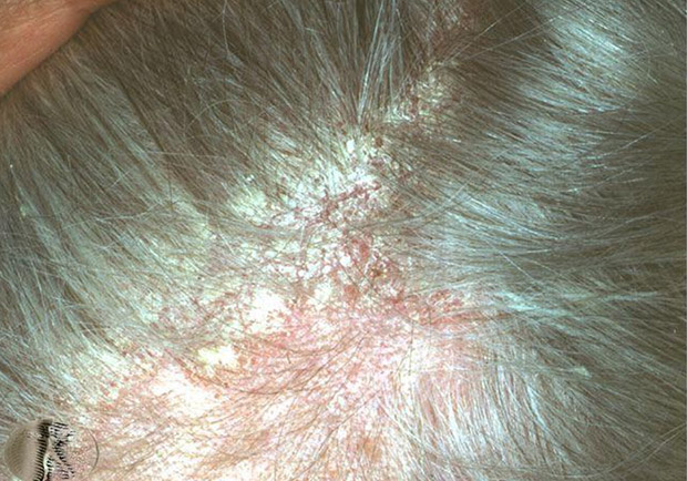 紅腫發炎又脫屑,脂漏性皮膚炎如何保養及根治?_img_1