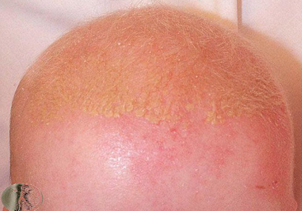 紅腫發炎又脫屑,脂漏性皮膚炎如何保養及根治?_img_2