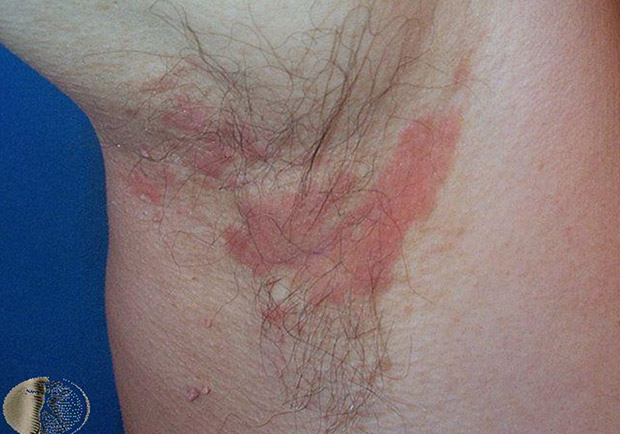 紅腫發炎又脫屑,脂漏性皮膚炎如何保養及根治?_img_5