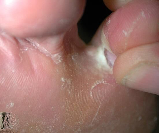 香港腳如何根治、保養與預防?醫師圖文完整解答_img_2