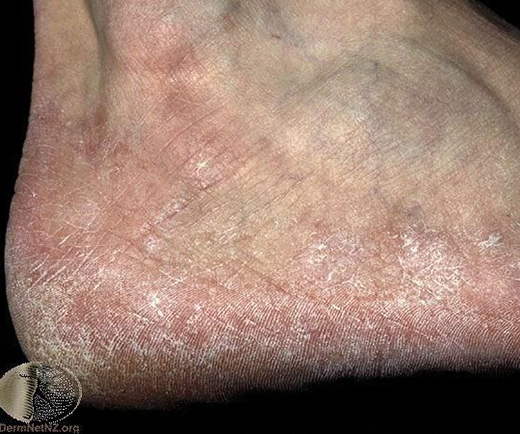 香港腳如何根治、保養與預防?醫師圖文完整解答_img_3