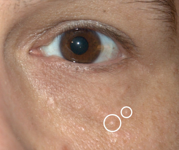 眼睛附近的肉芽你會分嗎?汗管瘤、粟粒腫的保養與治療全攻略_img_1