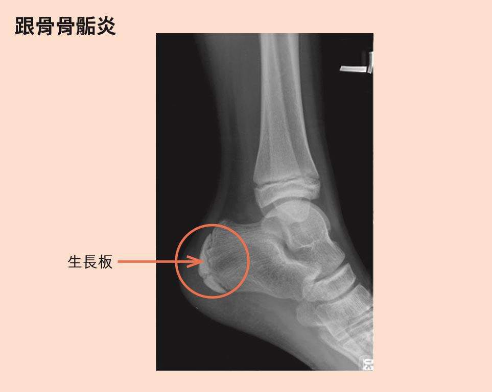 孩子遇到莫名腳跟痛,家長別再以為只是生長痛!_img_1